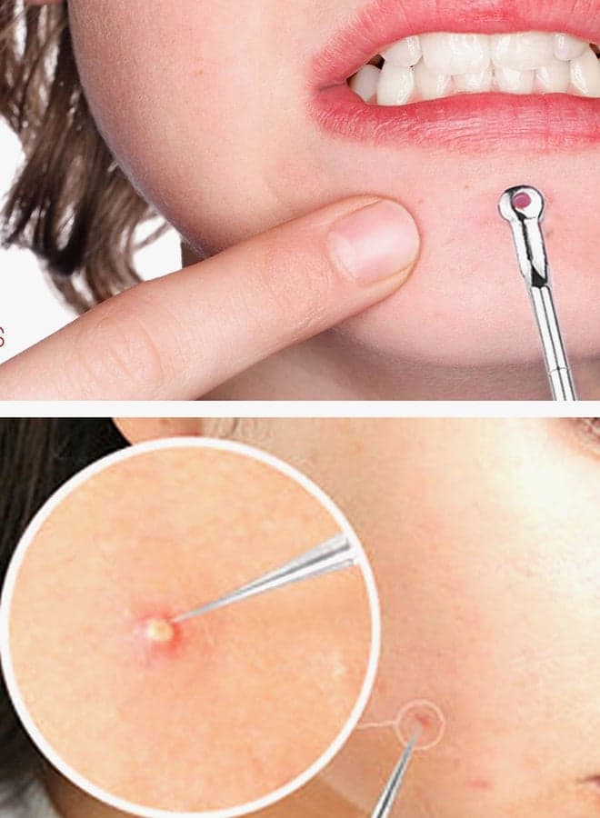4 Piece Acne Needles Set Silver Blackhead & Acne Remover (٦)